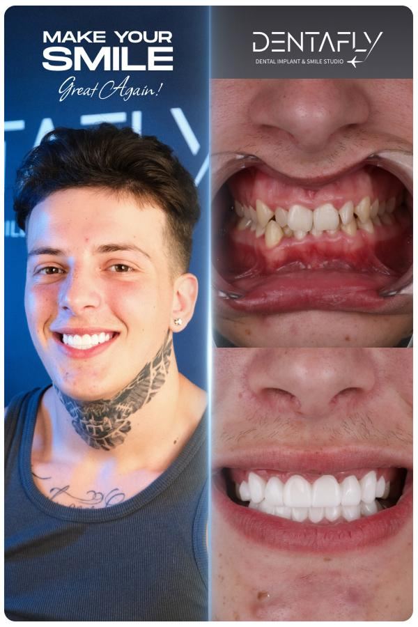 Dental implant and smile-design before and after — clinic group case 7