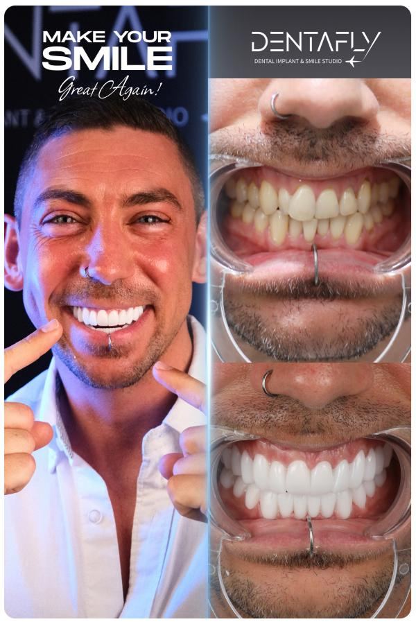 Dental implant and smile-design before and after — clinic group case 8